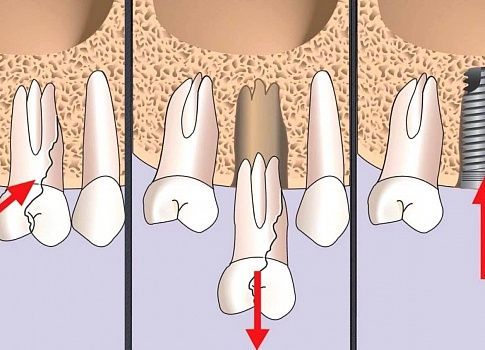 Можно ли удалить зуб и установить имплант в 1 посещение?