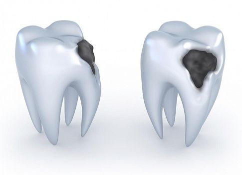 Почему разрушаются зубы? Советы по лечению зубов