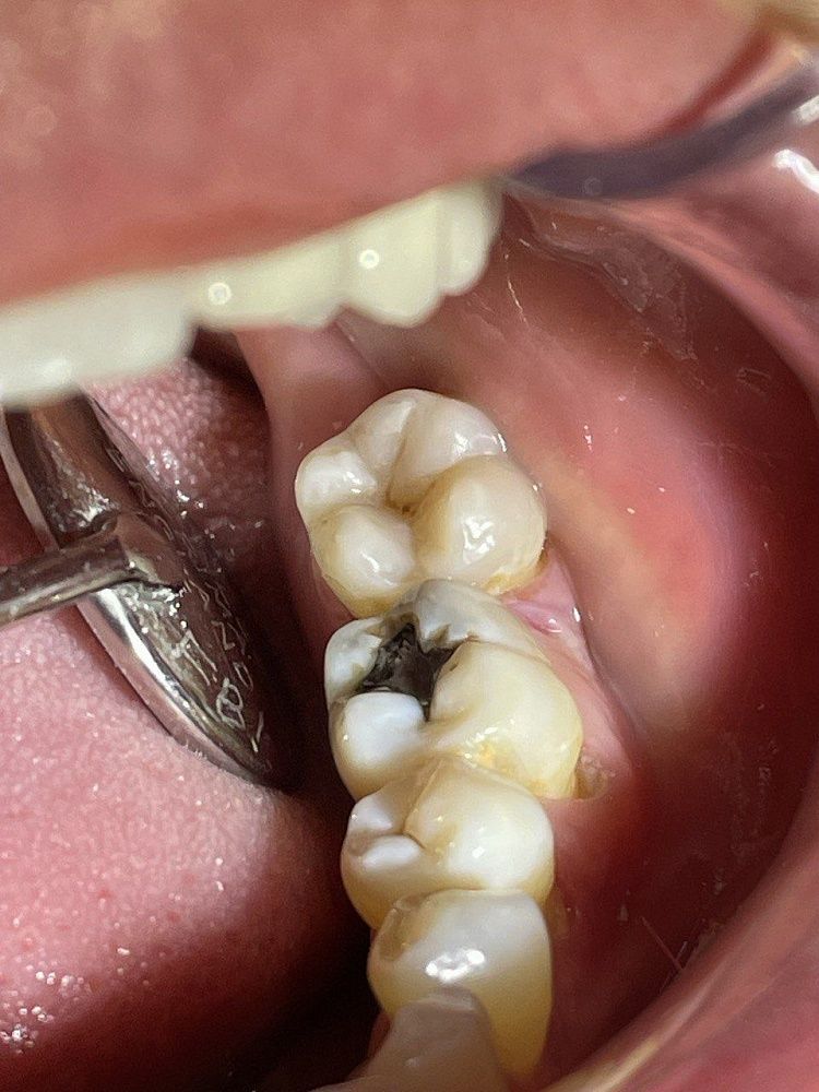 Полное анатомическое восстановление цвета и формы зуба, с тонировкой фиссур