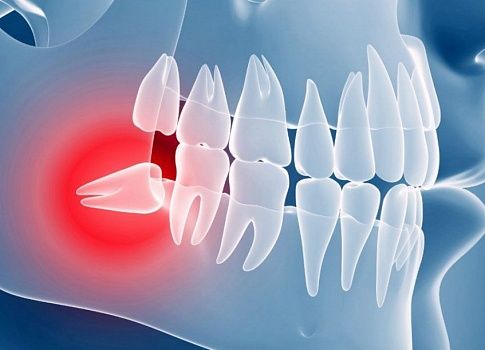 Сильно болит зуб мудрости: почему это происходит и что можно предпринять до похода к стоматологу?