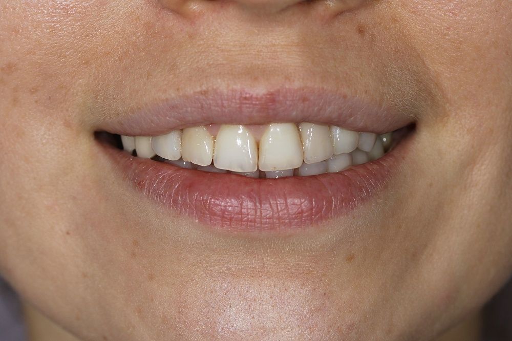 Закрытие трем эстетическим композитом нижних фронтальных зубов, эстетические композитные реставрации верхних фронтальных зубов