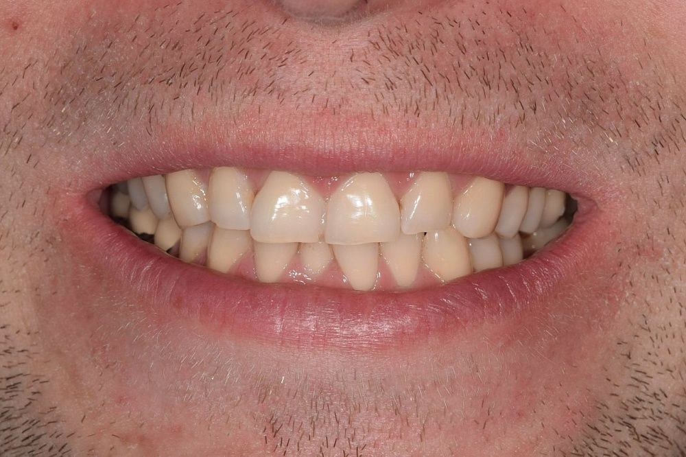 Эстетические композитные реставрации зубов верхней и нижней челюсти после ортодонтического лечения