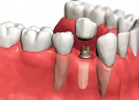 Как ставят зубные импланты?