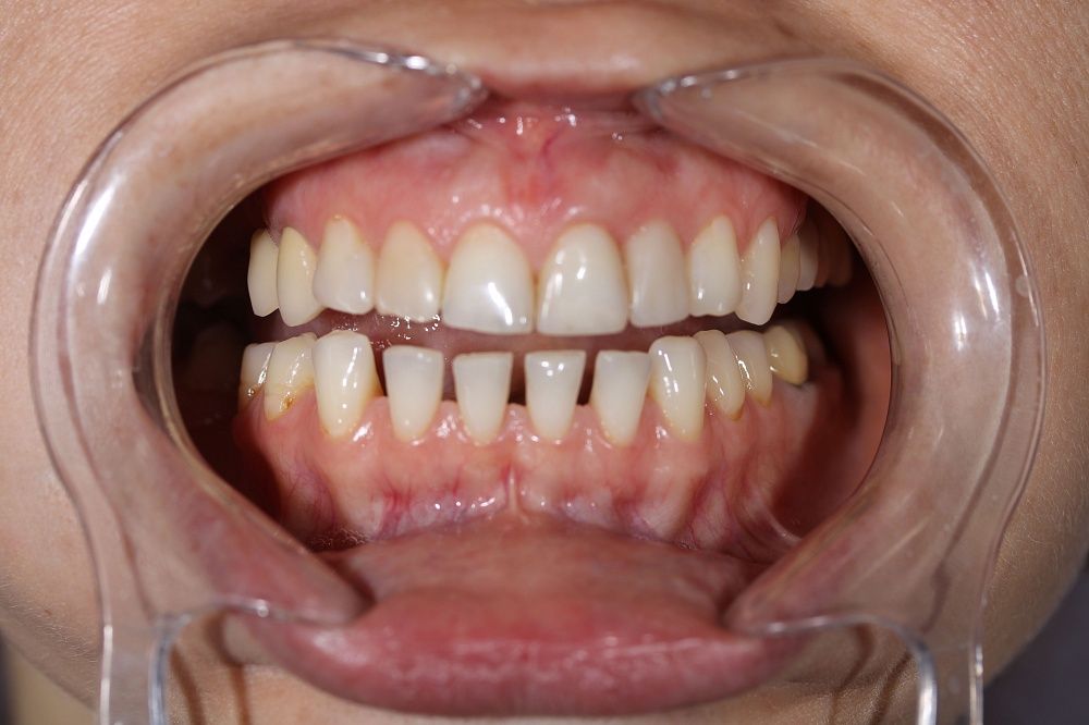 Закрытие трем эстетическим композитом нижних фронтальных зубов, эстетические композитные реставрации верхних фронтальных зубов