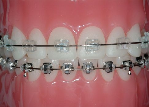 Почему болят зубы после установки брекетов и их снятия, что поможет избавиться от боли?