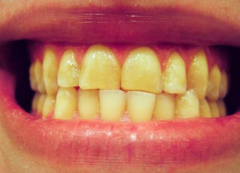 Почему желтеют зубы?