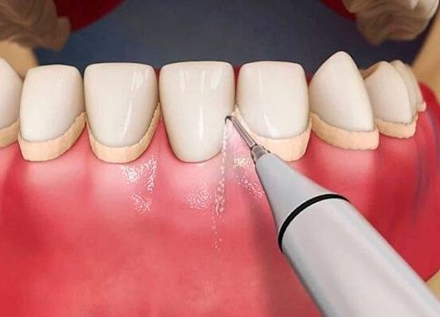 Профессиональная чистка зубов — что это такое?