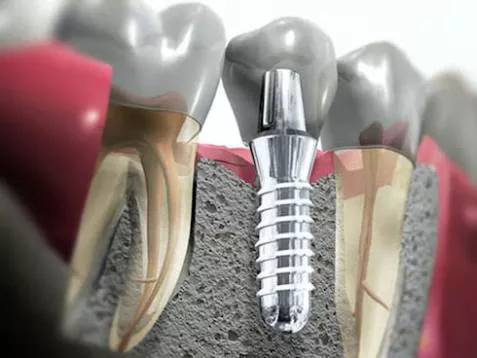 зубной имплантат наглядно