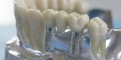 зубной имплантат двойной